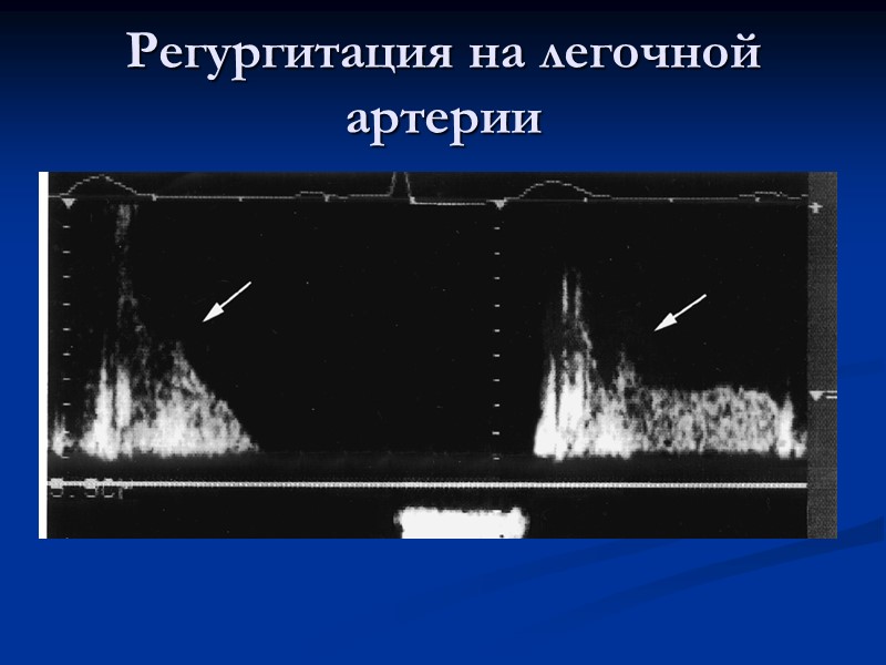Регургитация на легочной артерии